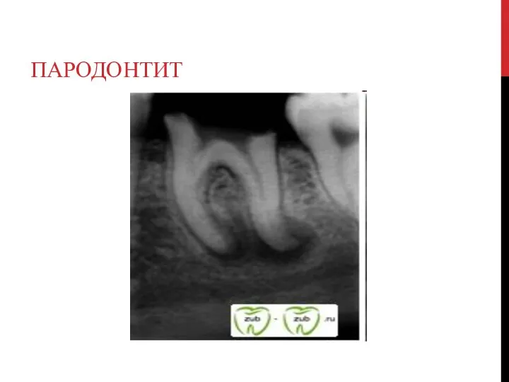 ПАРОДОНТИТ