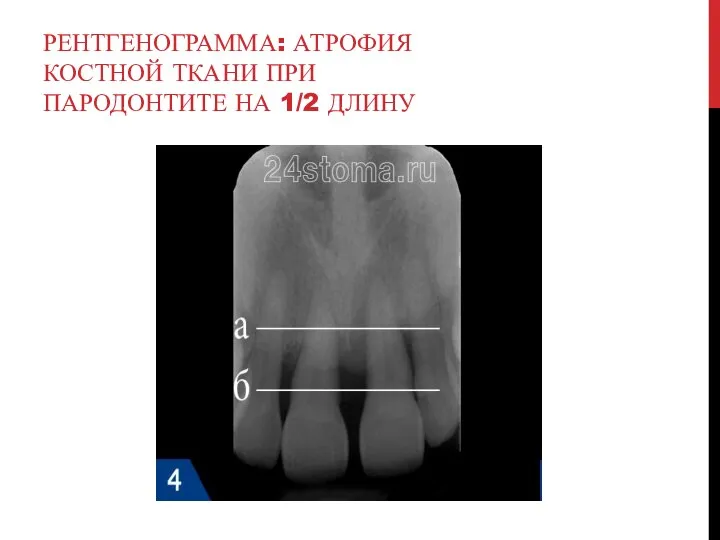 РЕНТГЕНОГРАММА: АТРОФИЯ КОСТНОЙ ТКАНИ ПРИ ПАРОДОНТИТЕ НА 1/2 ДЛИНУ