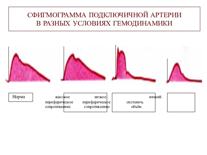 СФИГМОГРАММА ПОДКЛЮЧИЧНОЙ АРТЕРИИ В РАЗНЫХ УСЛОВИЯХ ГЕМОДИНАМИКИ Норма высокое низкое низкий