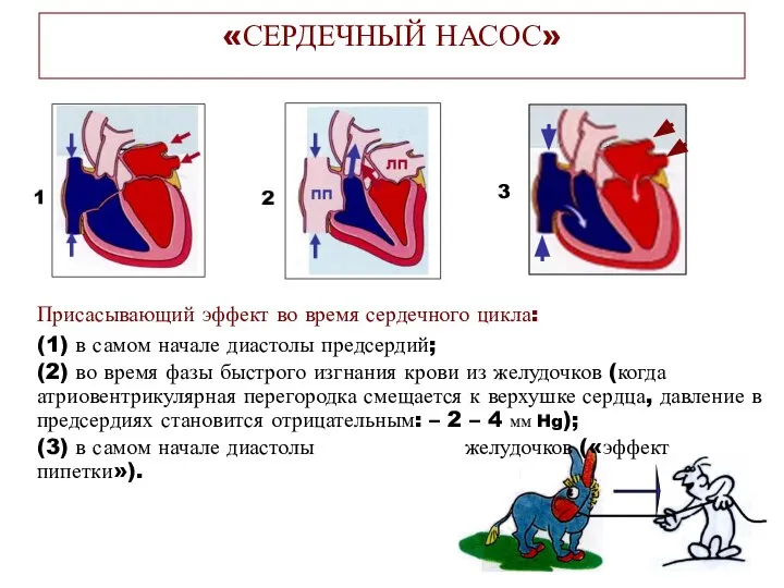 Присасывающий эффект во время сердечного цикла: (1) в самом начале диастолы