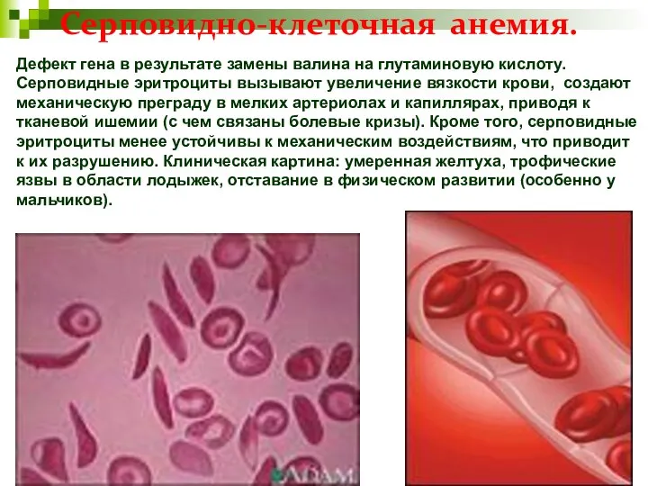 Серповидно-клеточная анемия. Дефект гена в результате замены валина на глутаминовую кислоту.