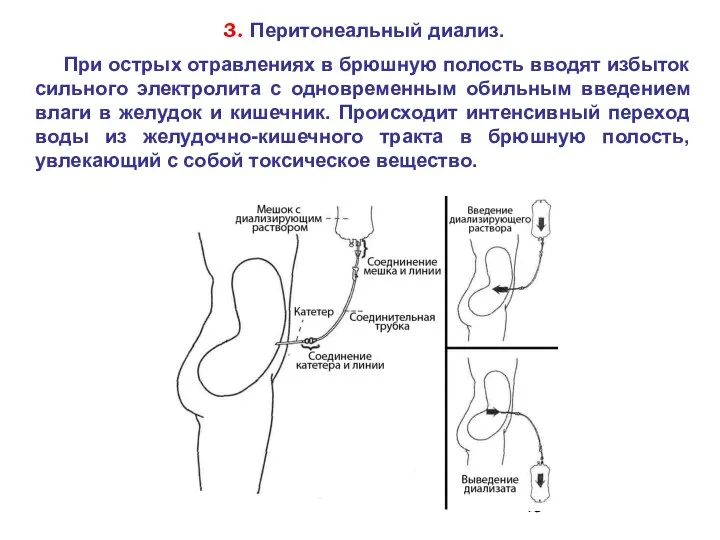 3. Перитонеальный диализ. При острых отравлениях в брюшную полость вводят избыток