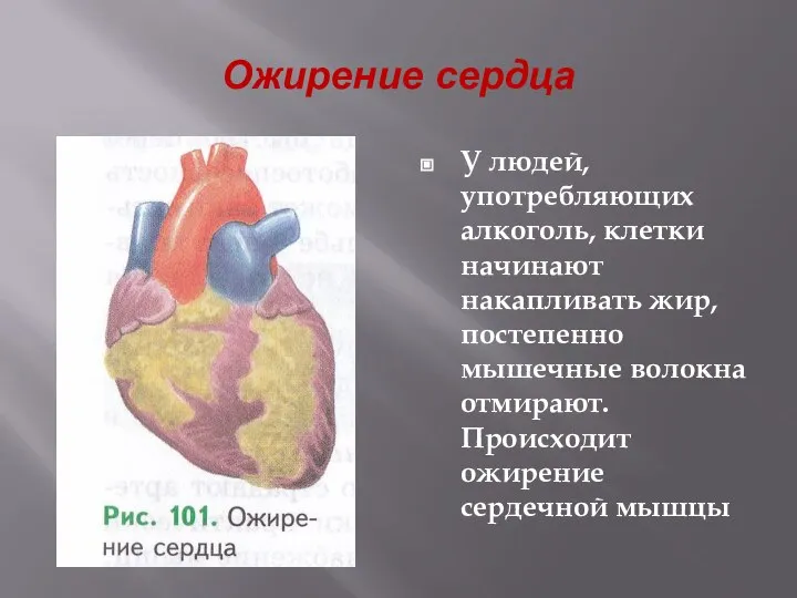 Ожирение сердца У людей, употребляющих алкоголь, клетки начинают накапливать жир, постепенно