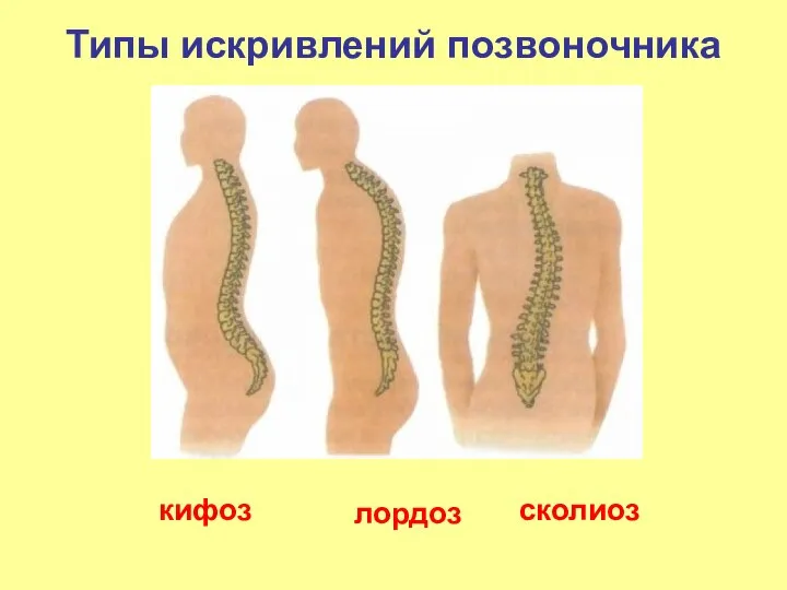 Типы искривлений позвоночника кифоз лордоз сколиоз