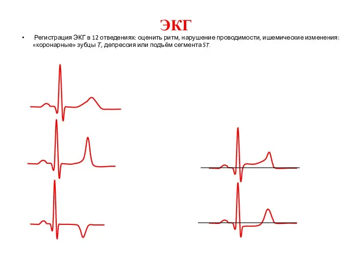 ЭКГ Регистрация ЭКГ в 12 отведениях: оценить ритм, нарушение проводимости, ишемические