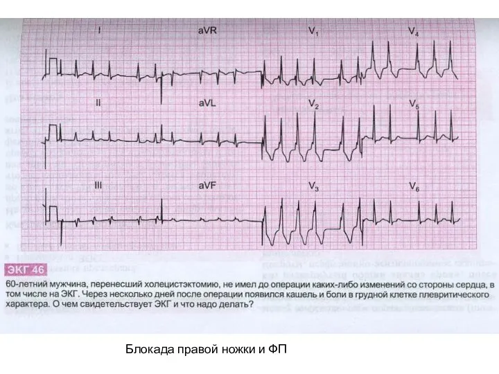 Блокада правой ножки и ФП
