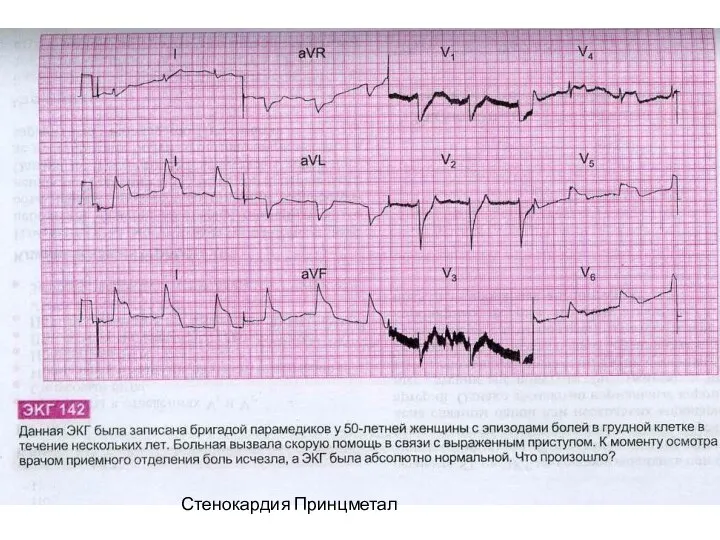 Стенокардия Принцметал