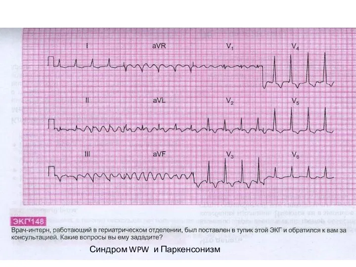 Синдром WPW и Паркенсонизм