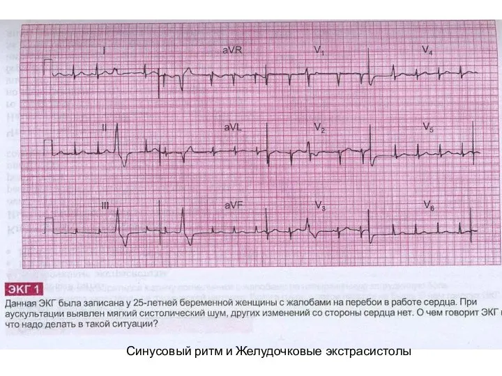 Синусовый ритм и Желудочковые экстрасистолы