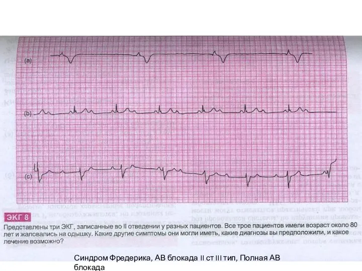 Синусовый ритм и Желудочковые экстрасистолы Синдром Фредерика, АВ блокада II ст III тип, Полная АВ блокада