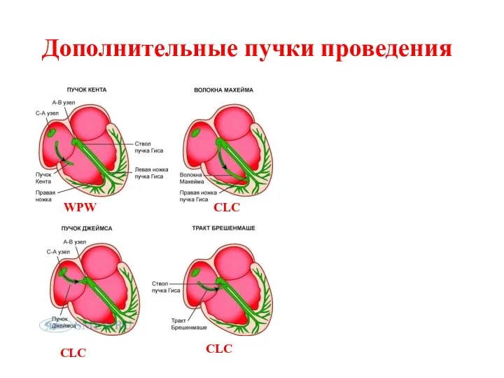 Дополнительные пучки проведения CLC WPW CLC CLC