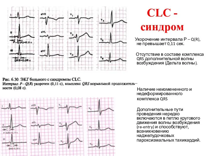 CLC - синдром Укорочение интервала Р – Q(R), не превышает 0,11