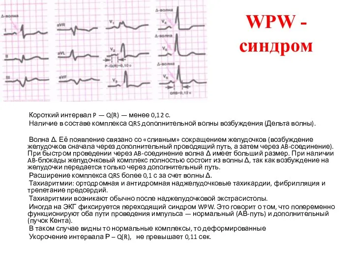 WPW - синдром Короткий интервал P — Q(R) — менее 0,12