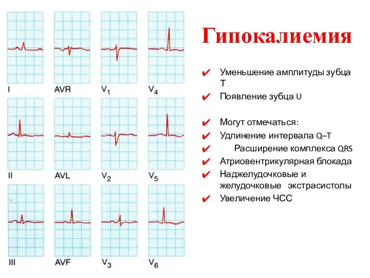 Гипокалиемия Уменьшение амплитуды зубца Т Появление зубца U Могут отмечаться: Удлинение
