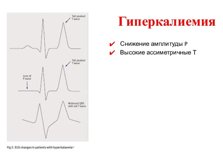 Гиперкалиемия Снижение амплитуды P Высокие ассиметричные Т