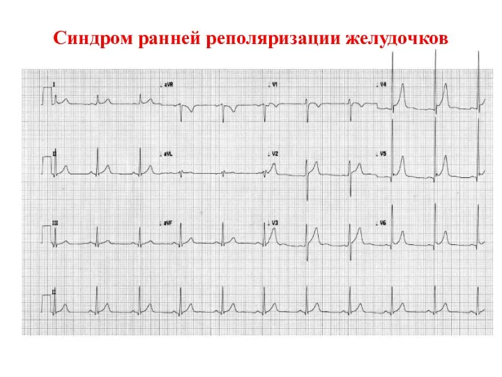 Синдром ранней реполяризации желудочков