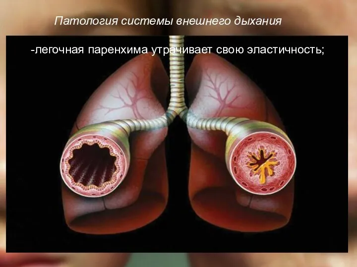 Патология системы внешнего дыхания -легочная паренхима утрачивает свою эластичность;