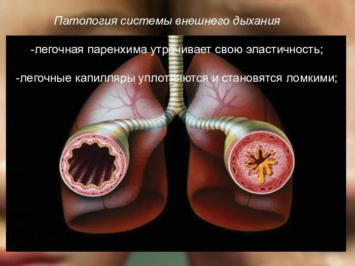 Патология системы внешнего дыхания -легочная паренхима утрачивает свою эластичность; -легочные капилляры уплотняются и становятся ломкими;