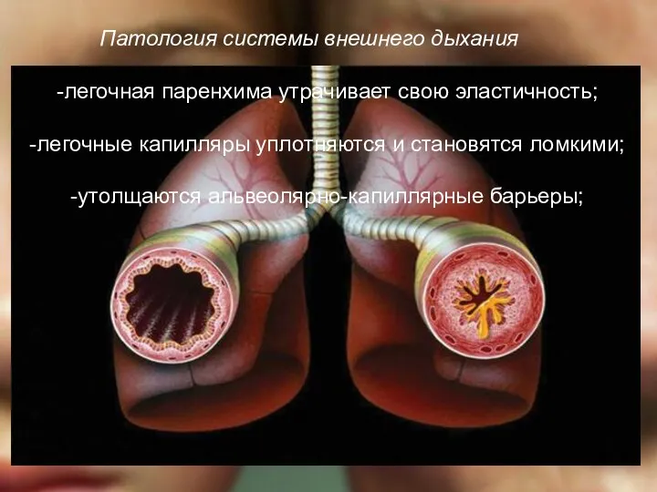 Патология системы внешнего дыхания -легочная паренхима утрачивает свою эластичность; -легочные капилляры
