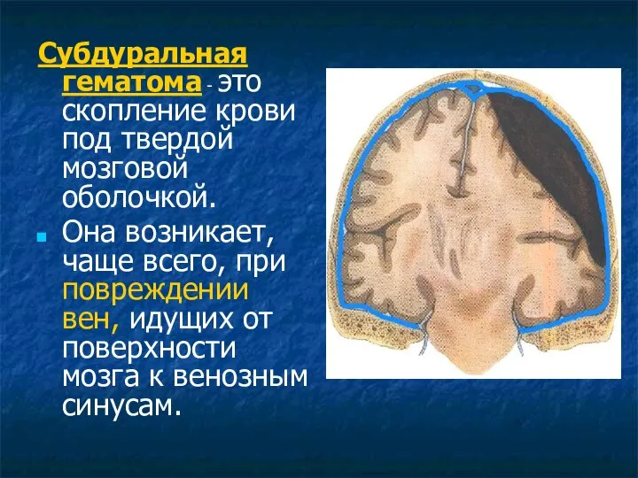 Субдуральная гематома - это скопление крови под твердой мозговой оболочкой. Она