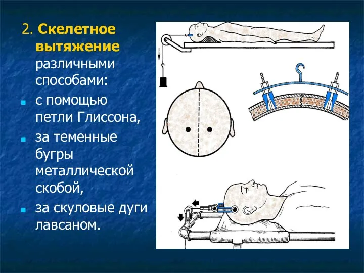 2. Скелетное вытяжение различными способами: с помощью петли Глиссона, за теменные