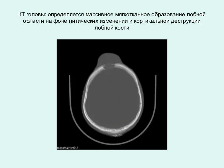 КТ головы: определяется массивное мягкотканное образование лобной области на фоне литических