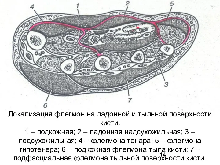 Локализация флегмон на ладонной и тыльной поверхности кисти. 1 – подкожная;