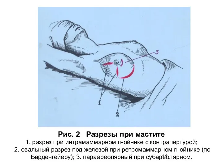 Рис. 2 Разрезы при мастите 1. разрез при интрамаммарном гнойнике с