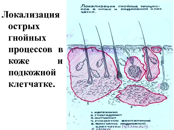 Локализация острых гнойных процессов в коже и подкожной клетчатке.