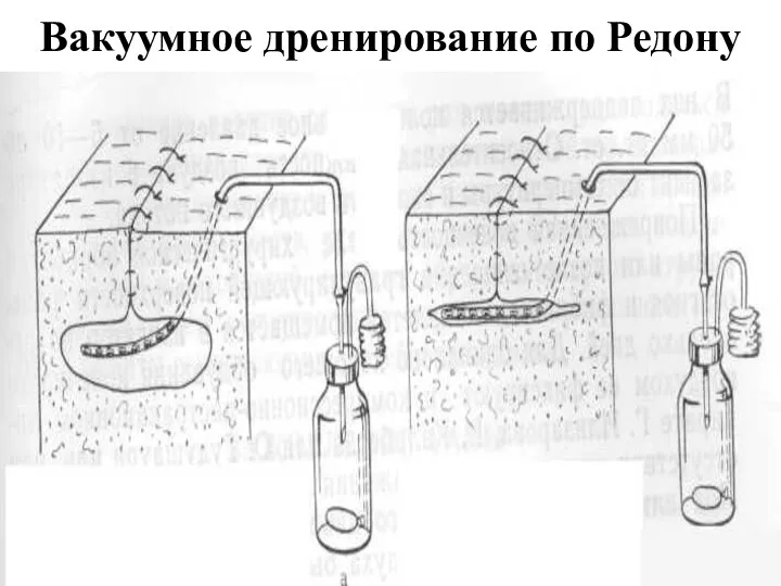 Вакуумное дренирование по Редону