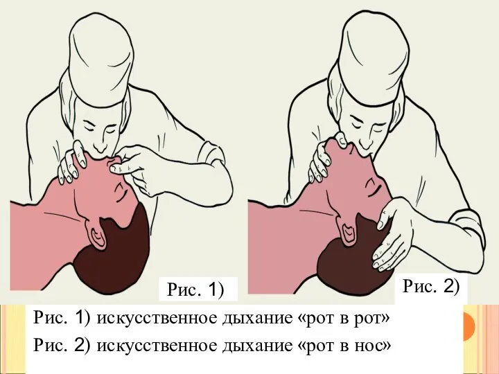 а.) б.) Рис. 1) искусственное дыхание «рот в рот» Рис. 2)