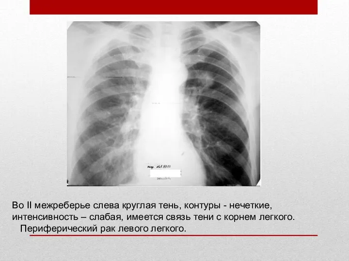 Во II межреберье слева круглая тень, контуры - нечеткие, интенсивность –