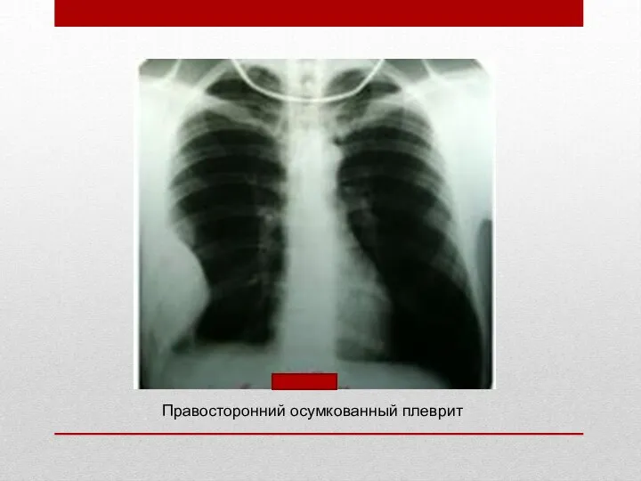 Правосторонний осумкованный плеврит