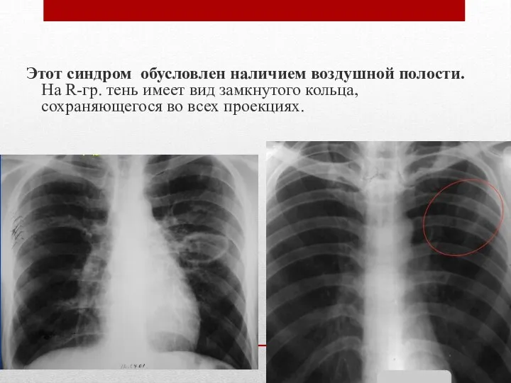 Этот синдром обусловлен наличием воздушной полости. На R-гр. тень имеет вид