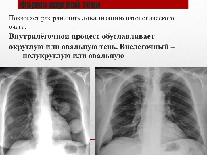 Форма круглой тени Позволяет разграничить локализацию патологического очага. Внутрилёгочной процесс обуславливает