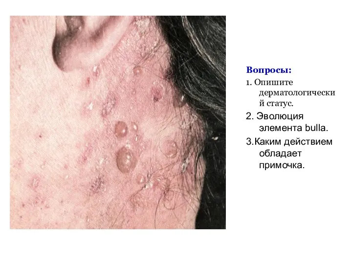 Вопросы: 1. Опишите дерматологический статус. 2. Эволюция элемента bulla. 3.Каким действием обладает примочка.