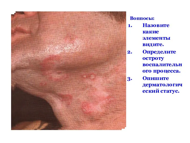 Воппосы: Назовите какие элементы видите. Определите остроту воспалительного процесса. Опишите дерматологический статус.