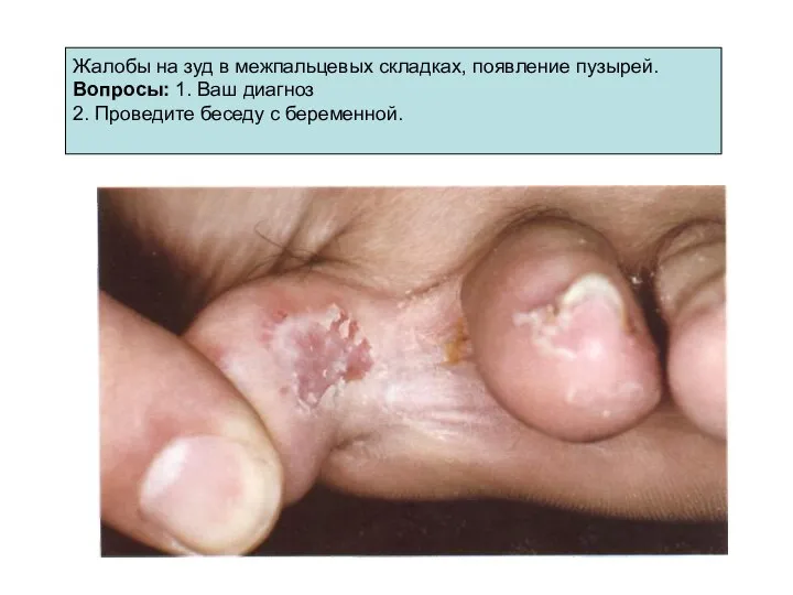 Жалобы на зуд в межпальцевых складках, появление пузырей. Вопросы: 1. Ваш
