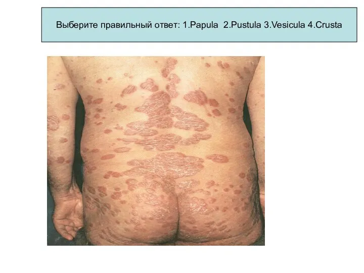 Выберите правильный ответ: 1.Papula 2.Pustula 3.Vesicula 4.Crusta