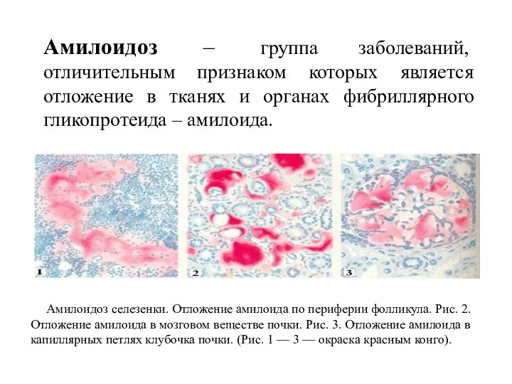 Амилоидоз – группа заболеваний, отличительным признаком которых является отложение в тканях