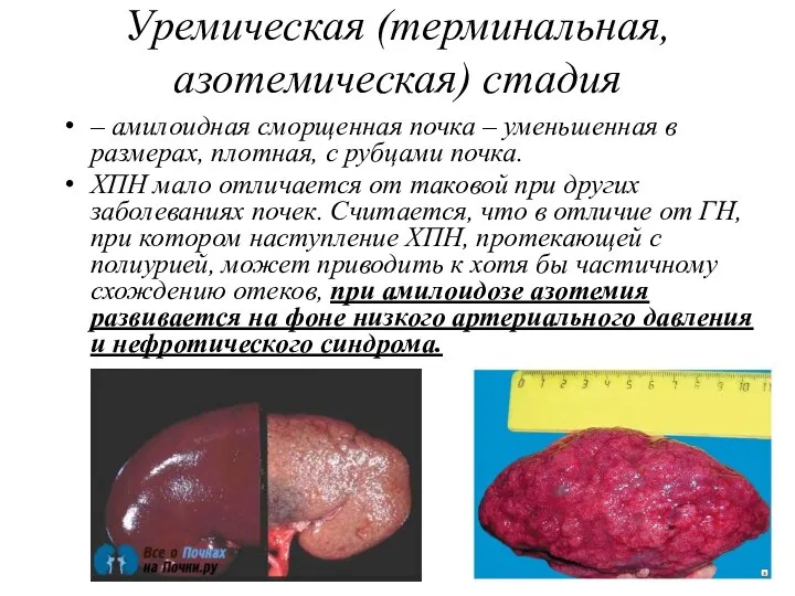 Уремическая (терминальная, азотемическая) стадия – амилоидная сморщенная почка – уменьшенная в