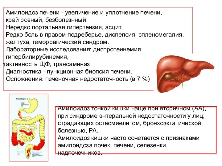 Амилоидоз печени - увеличение и уплотнение печени, край ровный, безболезнный. Нередко