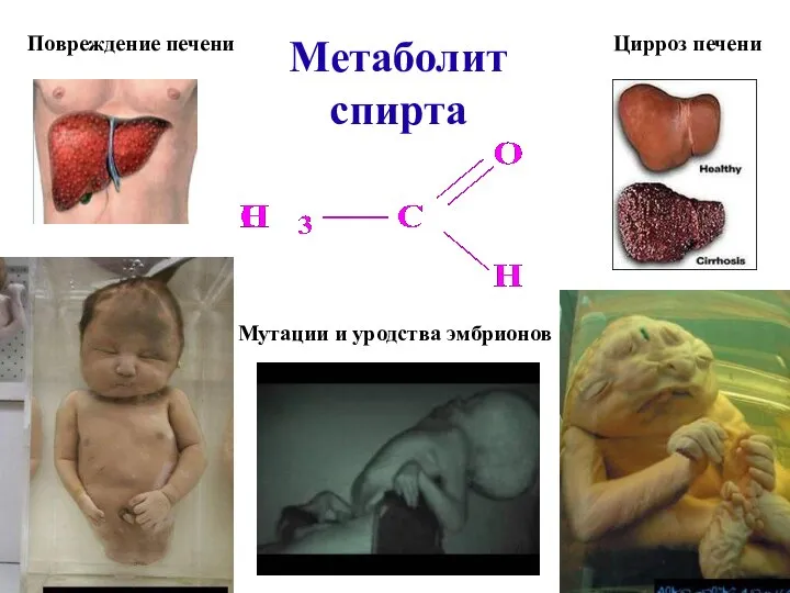 Метаболит спирта Повреждение печени Цирроз печени Мутации и уродства эмбрионов а