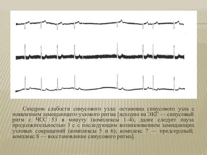 Синдром слабости синусового узла: остановка синусового узла с появлением замещающего узлового