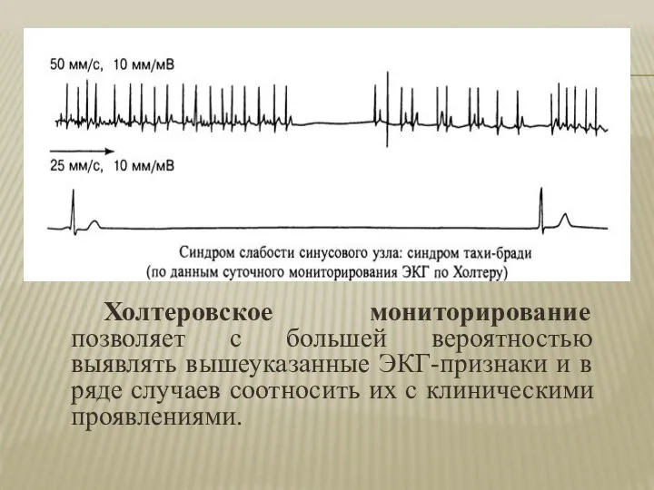 Холтеровское мониторирование позволяет с большей вероятностью выявлять вышеуказанные ЭКГ-признаки и в