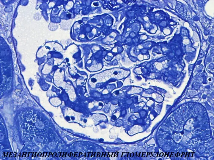 МЕЗАНГИОПРОЛИФЕРАТИВНЫЙ ГЛОМЕРУЛОНЕФРИТ
