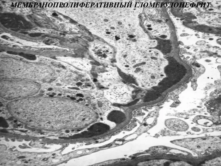 МЕМБРАНОПРОЛИФЕРАТИВНЫЙ ГЛОМЕРУЛОНЕФРИТ