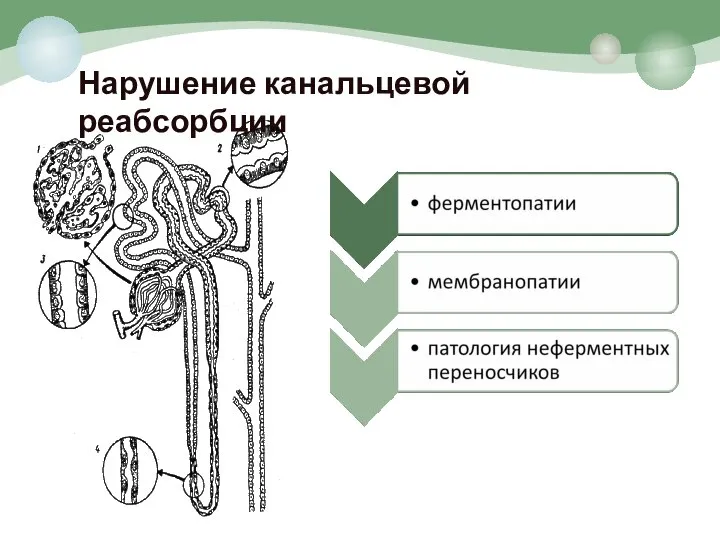 Нарушение канальцевой реабсорбции