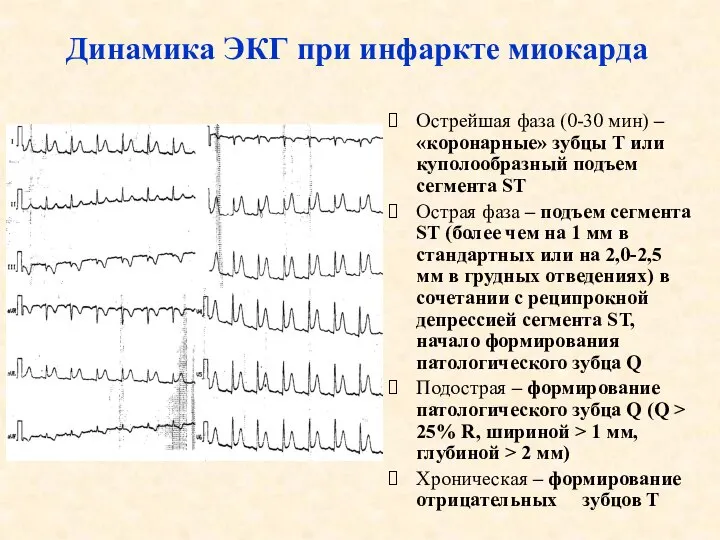 Острейшая фаза (0-30 мин) – «коронарные» зубцы Т или куполообразный подъем