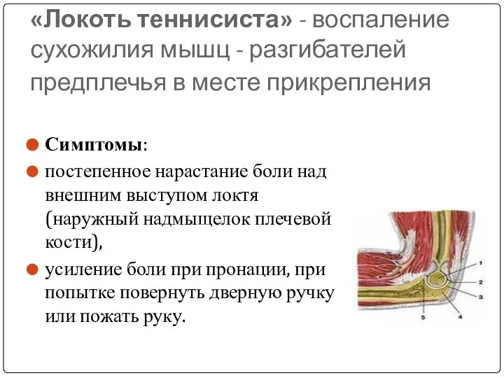 «Локоть теннисиста» - воспаление сухожилия мышц - разгибателей предплечья в месте